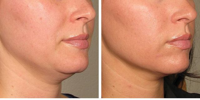 before-after-results-under-chin18-1552334868.jpg
